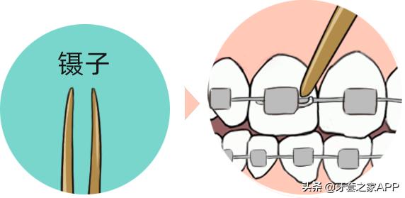 疫情复诊牙套能用吗现在,疫情期间牙齿出现问题怎么办