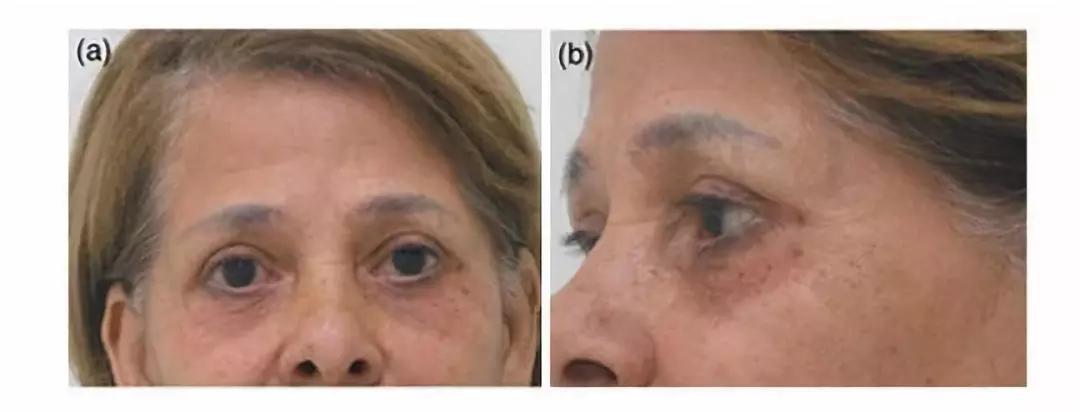 黑眼圈只是熬夜,熬夜狠了怎么拯救黑眼圈