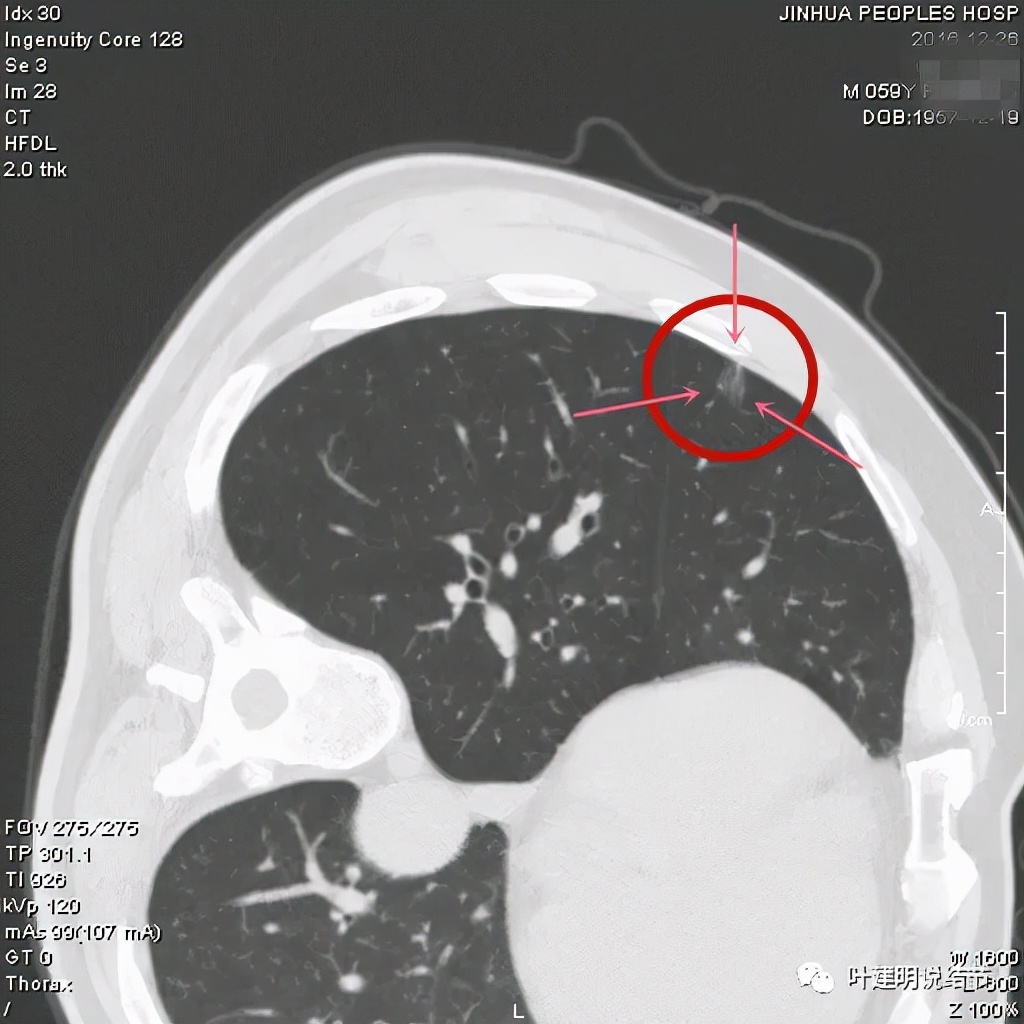 怎样从病理报告看是不是原位癌,原位腺癌切除子宫要开刀吗
