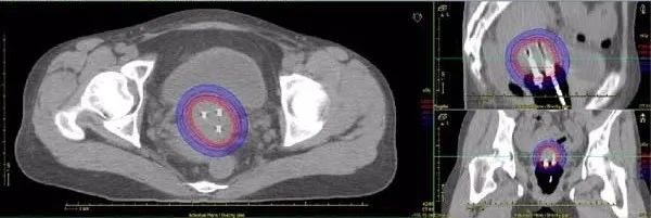 近距离放疗的副作用,近距离放疗
