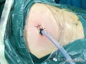 开胸手术断的肋骨怎么办,肋骨断了手术需要多少钱在上海