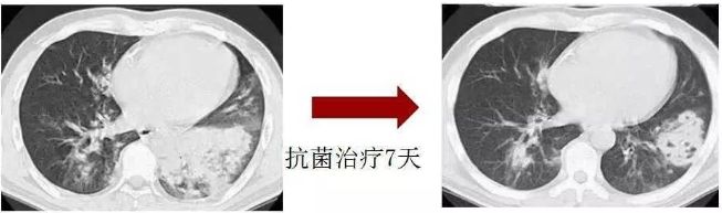 化脓性细菌感染用什么抗生素,化脓性细菌感染有痰用什么抗生素