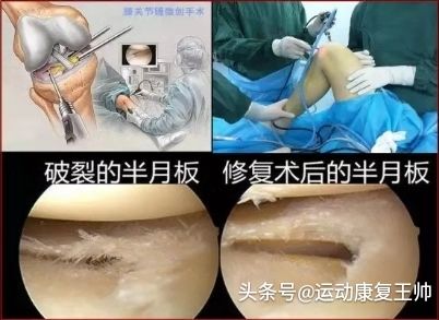 半月板损伤手术后多久能负重干活,半月板损伤后多久能负重