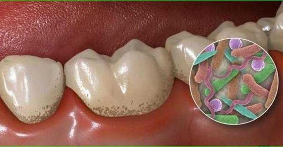 如何去除牙齿上的黑渍,如何去除牙齿上的黑渍用小苏打