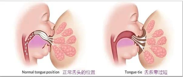 哺乳期乳房裂伤怎么办,乳房裂伤怎么办