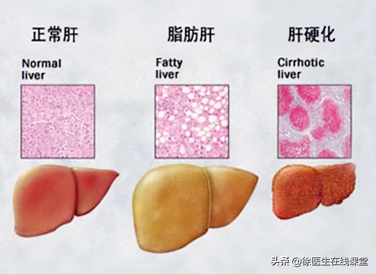 乙肝病毒携带者需要过分担心,乙肝携带者能过日子吗
