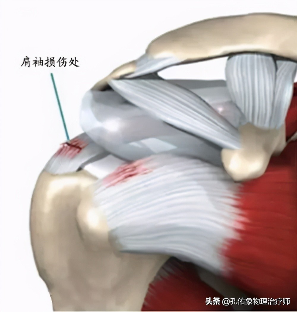 肩膀疼痛什么原因中医辨证治疗,整天肩膀酸痛怎么检查病因