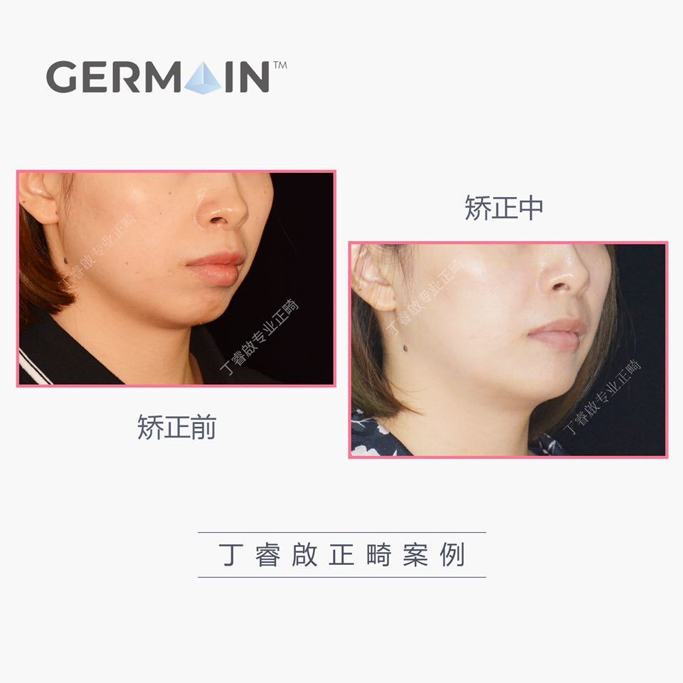 郑州牙齿矫正丁睿啟|下巴后缩病例合集