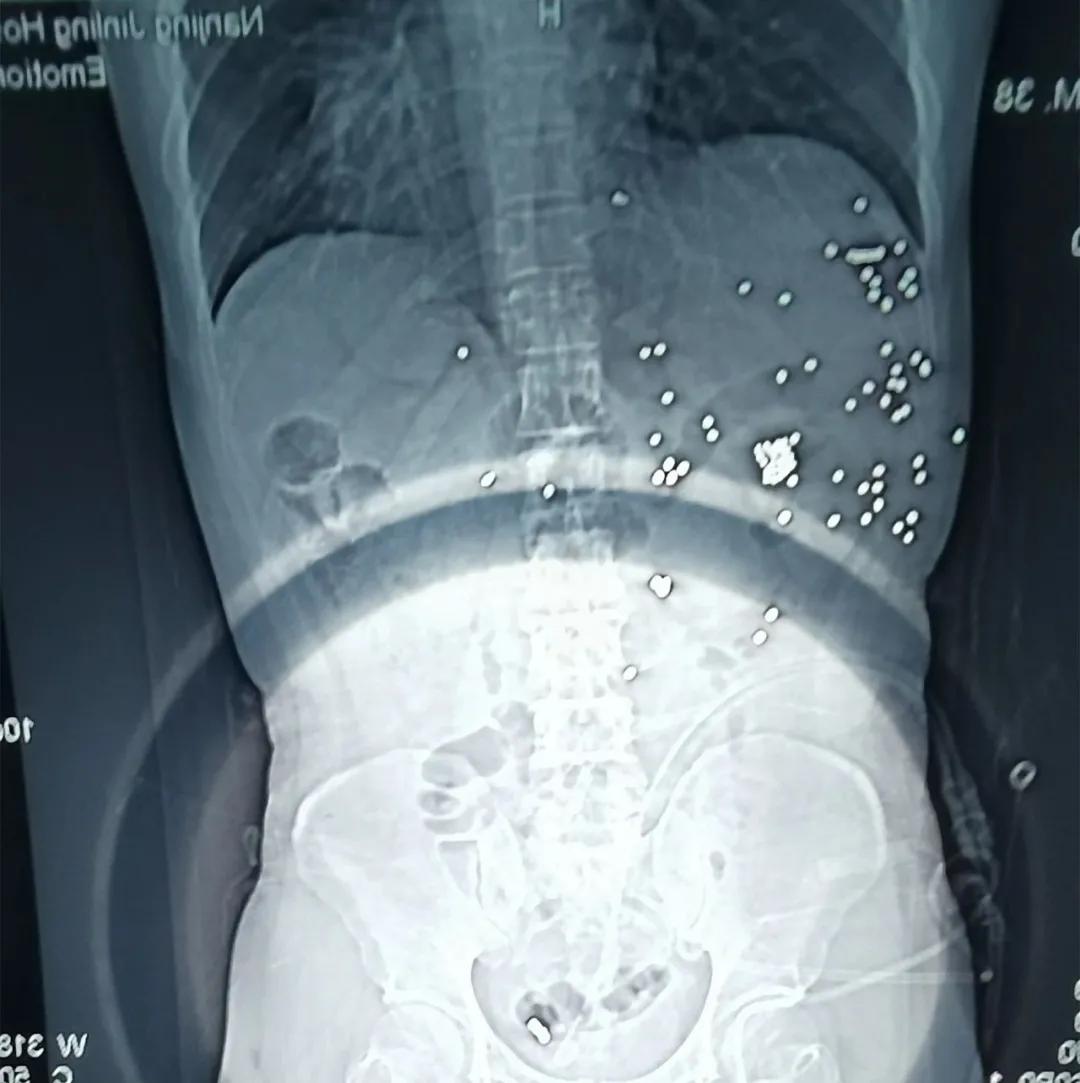 带着残留在体内的几十颗*弹霰**，他度过出院后第一个新年