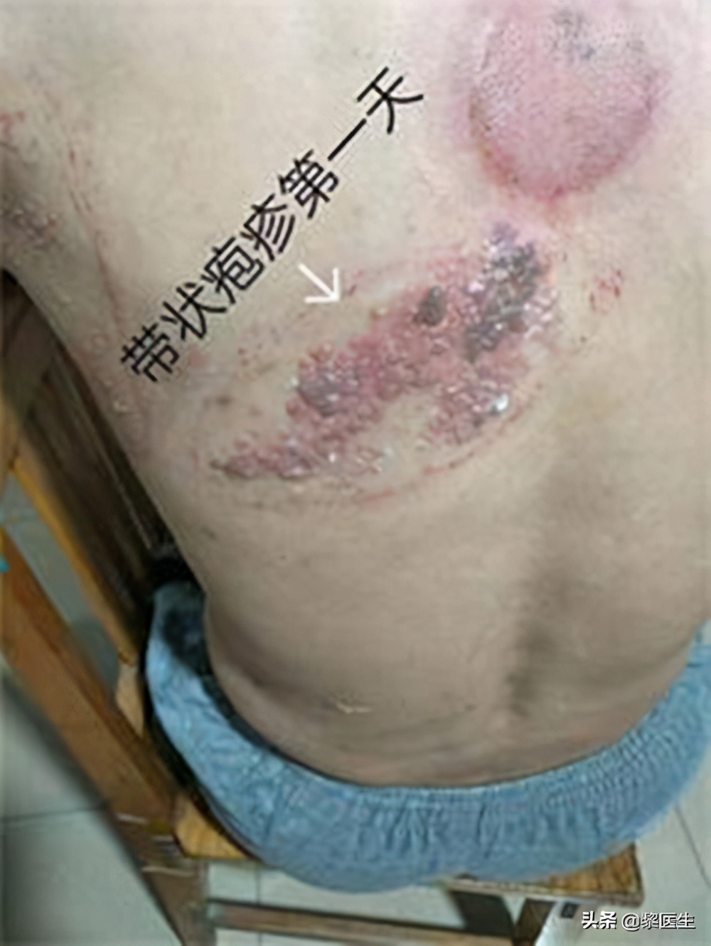 缠腰蛇的疱疹能弄烂吗,蛇缠腰带状疱疹引起神经痛严重吗