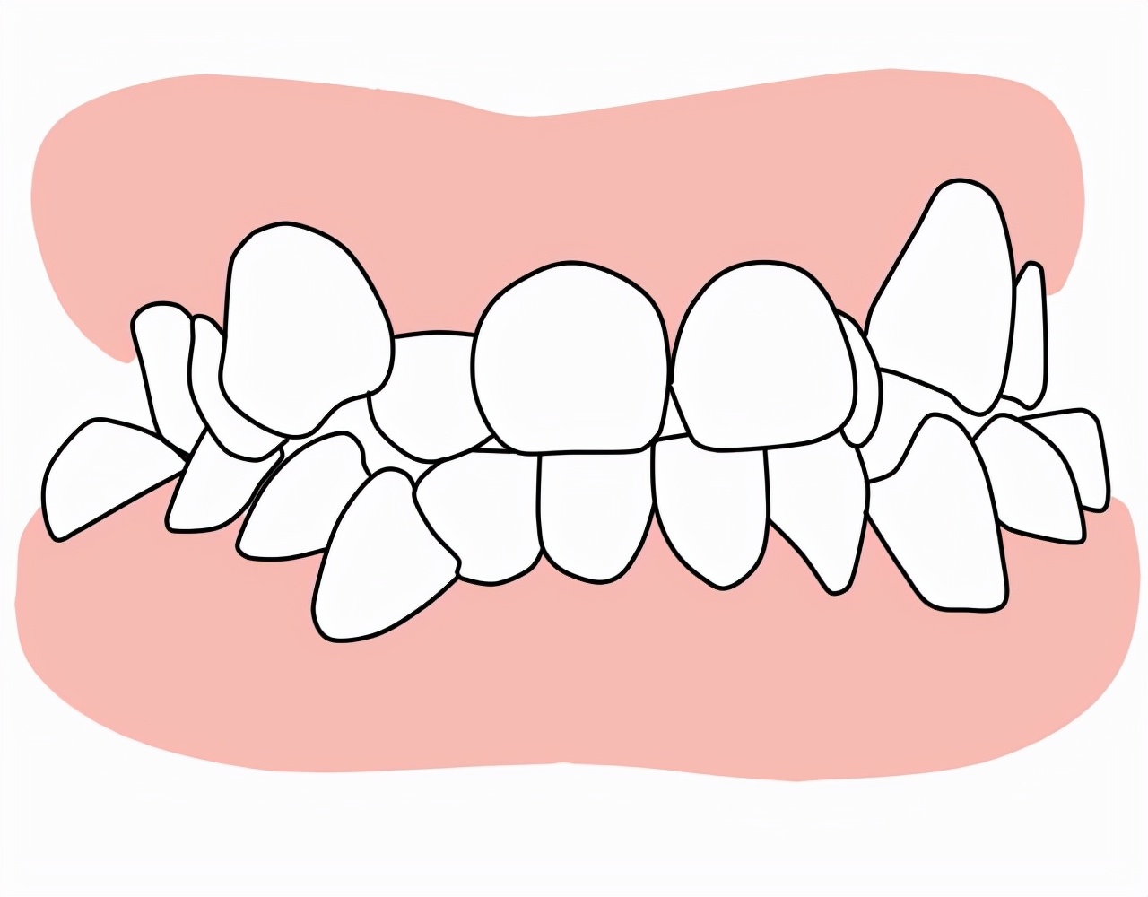 牙齿拥挤会导致缺牙吗,牙齿拥挤对脸型的影响