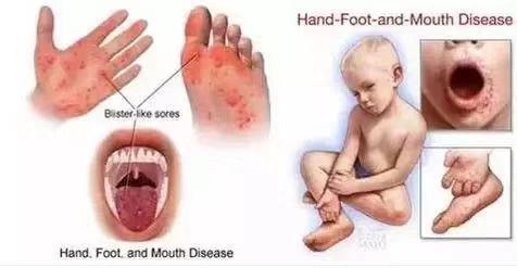 林俊杰患手足口病怎么办,林俊杰演唱会得了手足口病