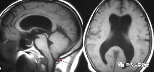 什么引起成人脑室扩大,哪些病可以导致左侧脑室增宽