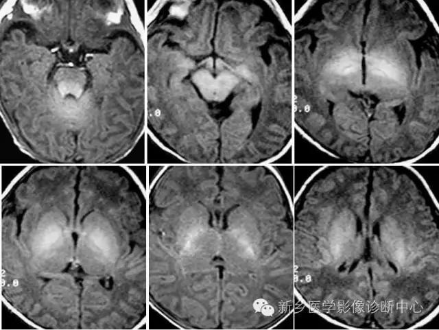 脱髓鞘样改变的mri表现,髓鞘形成稍延迟区