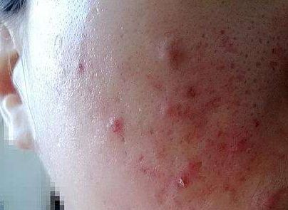 熬夜长的痘印能消下去吗,痘印怎么可以消下去