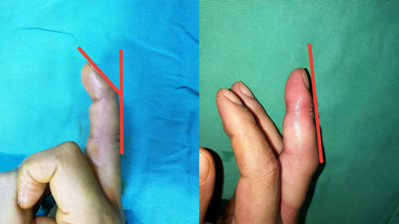 手指肌腱受伤伸不直多久手术合适,手指肌腱轻微损伤怎么治疗