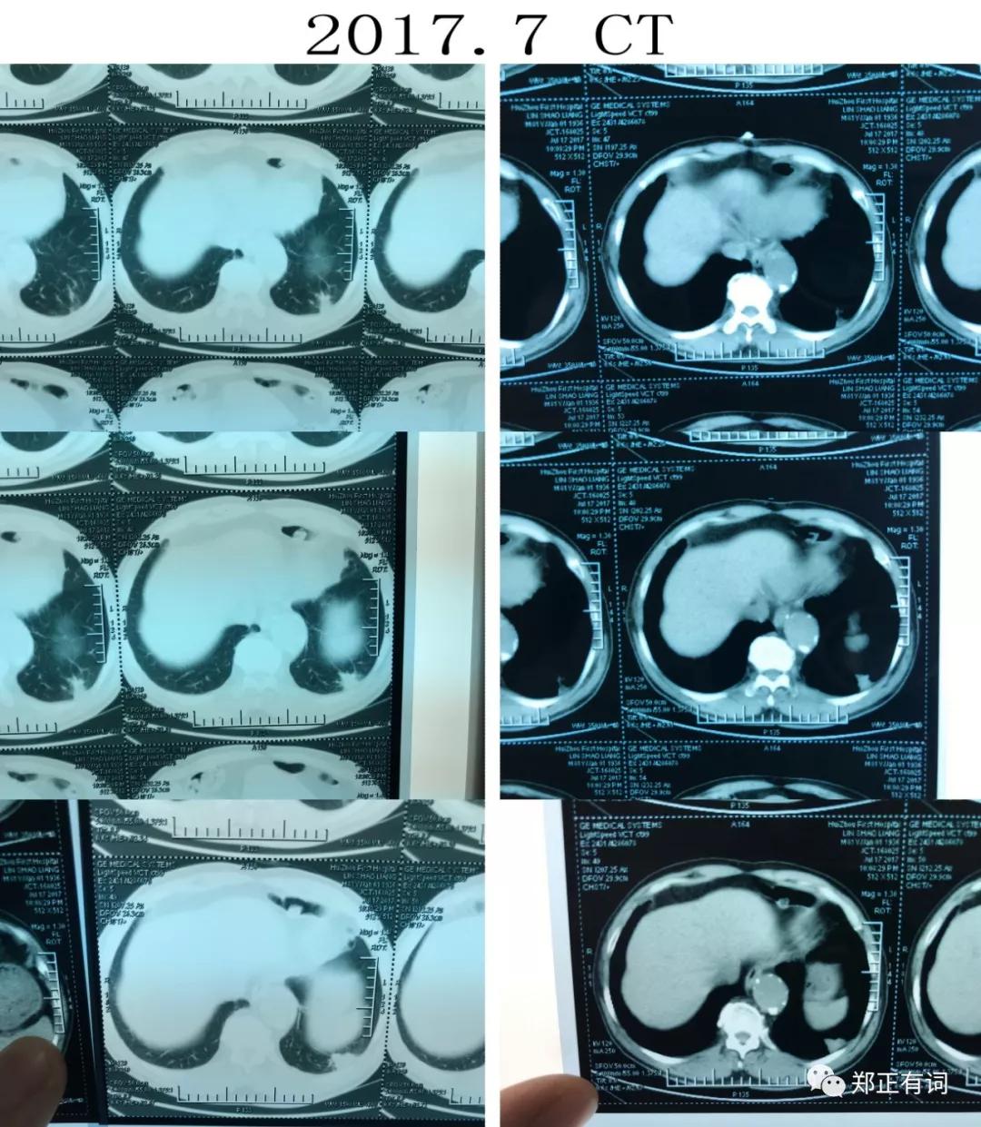 老年人肺癌不治疗能活多久,老年人得肺癌晚期不治疗能活多久