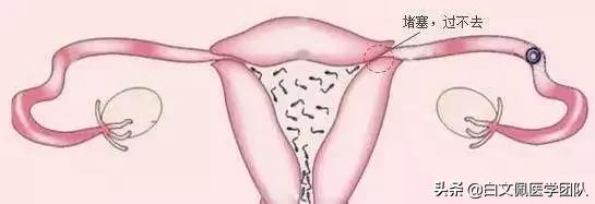 治疗输卵管近端不孕,输卵管性不孕的最佳治疗方法