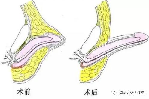 家长带孩子割包皮先了解这4点,家长陪孩子去医院割包皮