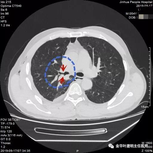 省级医院也漏诊?还好没耽误病情!我们予以行右中下叶袖式切除术