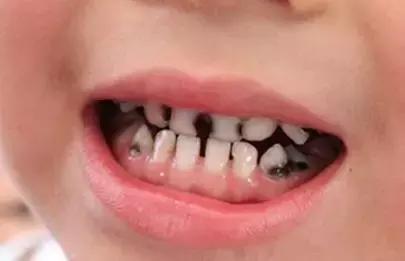 预防儿童蛀牙可打针预防吗,预防蛀牙可做窝沟封闭