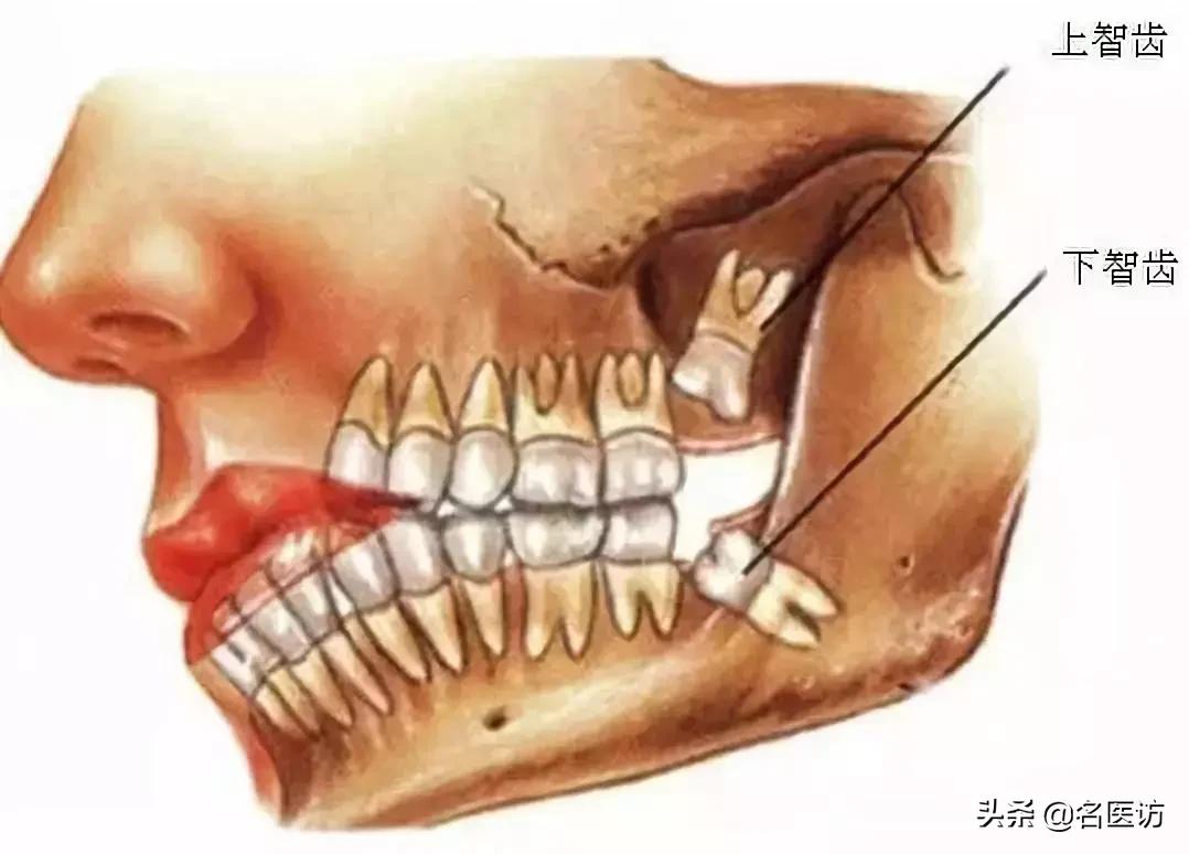 拔智齿有什么禁忌吗,拔智齿有什么禁忌