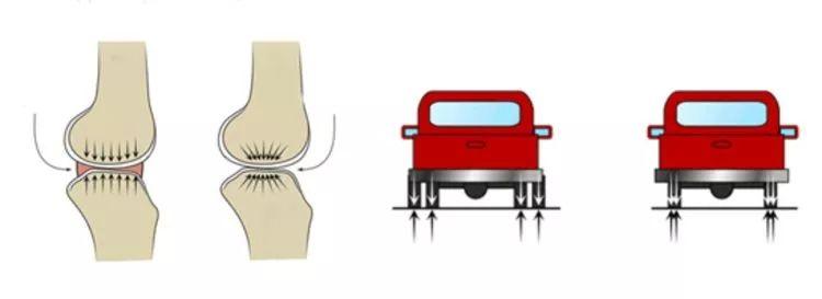 半月板损伤的成因和预防策略,关于半月板损伤的临床表现及诊断