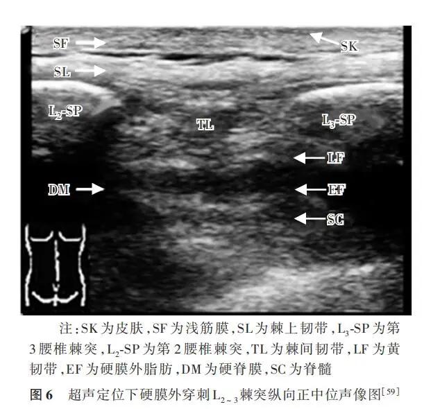 中国麻醉学2020版专家共识,硬膜外阻滞疗法
