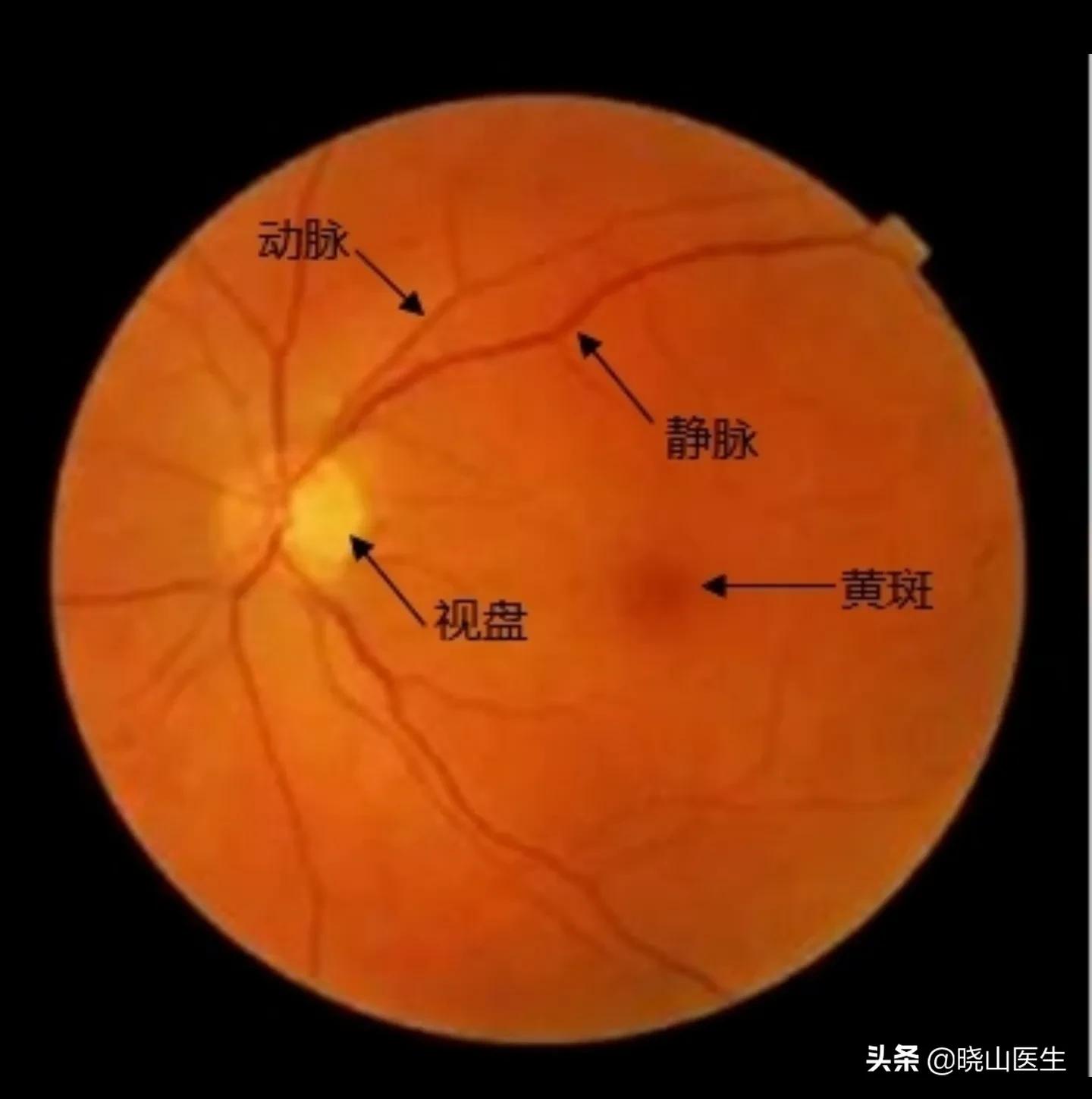 眼底检查塌陷,眼底筛查充血