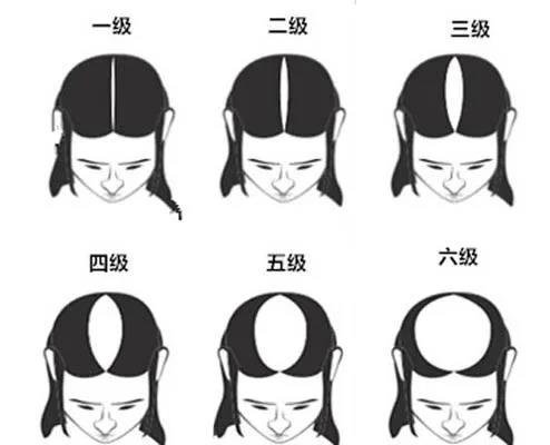 发量增多的实用小技巧,发量超级少的女生咋办啊