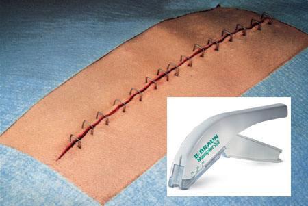 手术刀口上有订书钉怎么回事,手术伤口为什么要用订书针缝线