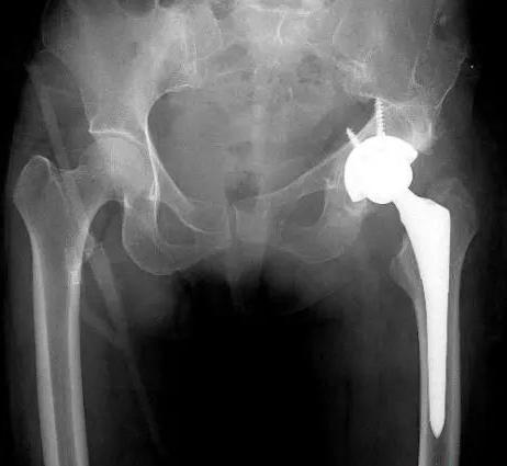 25岁股骨头疼痛什么原因,20年股骨头坏死怎么治