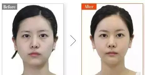 如何去眼袋拥有卧蚕,眼袋卧蚕和泪沟区别