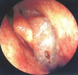 慢性鼻窦炎药物治疗原则,慢性鼻窦炎初步诊疗措施
