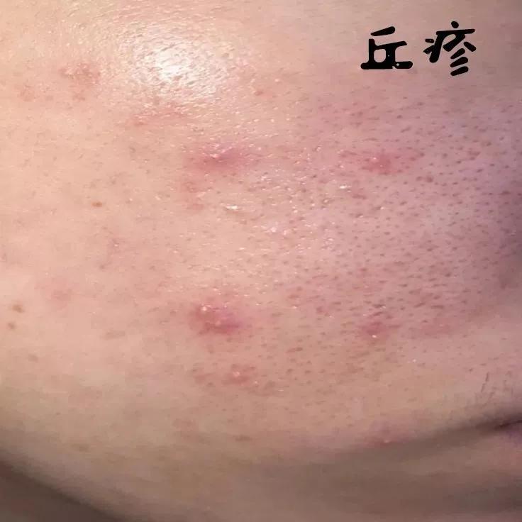 为什么你的痘印总是消不下去,为什么你的祛斑效果不理想