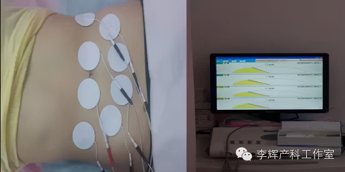 产后42天做盆底康复检查有必要吗,产后42天盆底康复做哪些检查