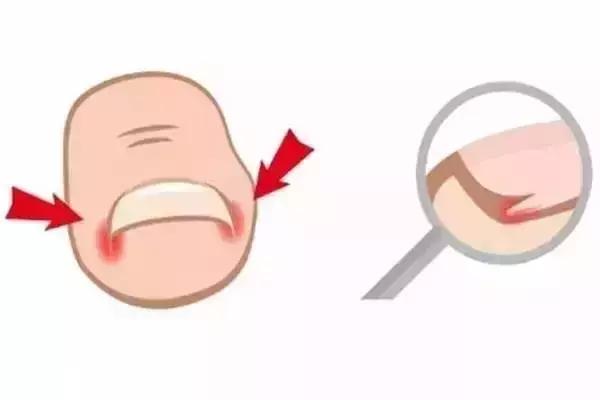 如何取出脚趾甲长进肉里,脚趾甲长进肉里需要拔甲吗