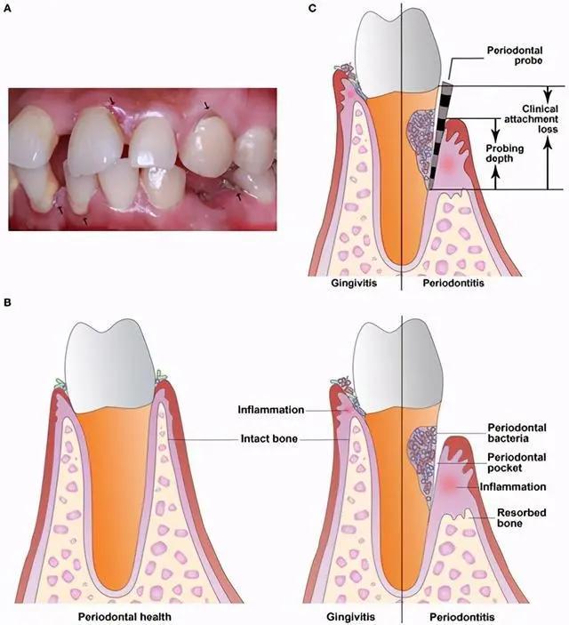 老年人牙疼最快止疼法,老年人牙疼是怎么回事