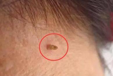 腋下脖子上长肉粒用什么药膏,腋下脖子上长小肉粒吃啥药