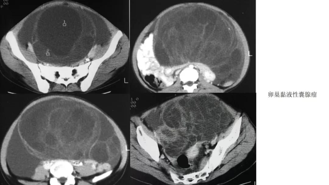 卵巢原发肿瘤的分析思路