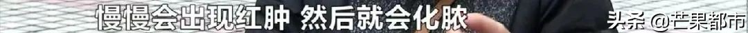 女子隆鼻后发炎流脓不止,女子花两万元变美鼻子却发炎化脓