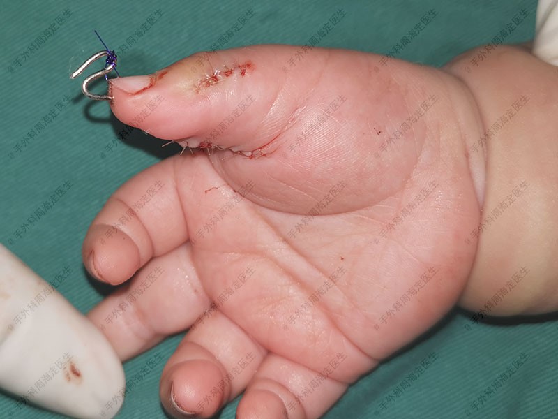 婴儿手指多指畸形有8个,婴儿手指多指是不是母体原因