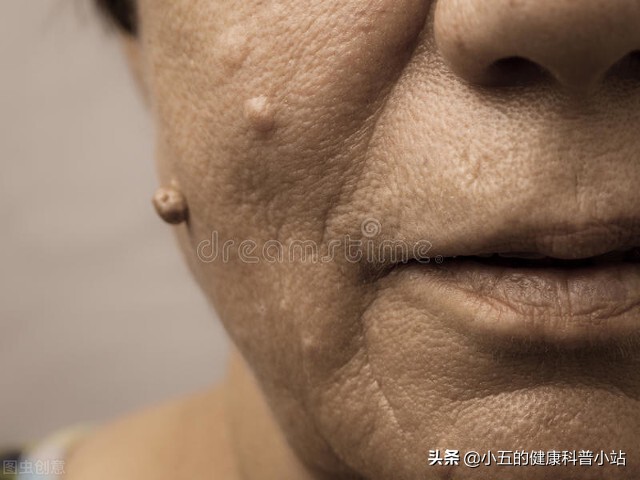 什么叫做脂肪瘤该怎么医治,脂肪瘤有什么危害脂肪瘤最怕什么