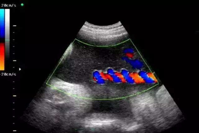 孕中期脐带扭转胎停的原因有哪些,胎儿脐带扭转是怎么回事