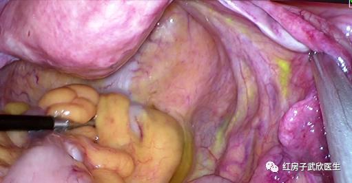 妇科胚胎性横纹肌肉瘤,宫颈早期胚胎性横纹肌肉瘤