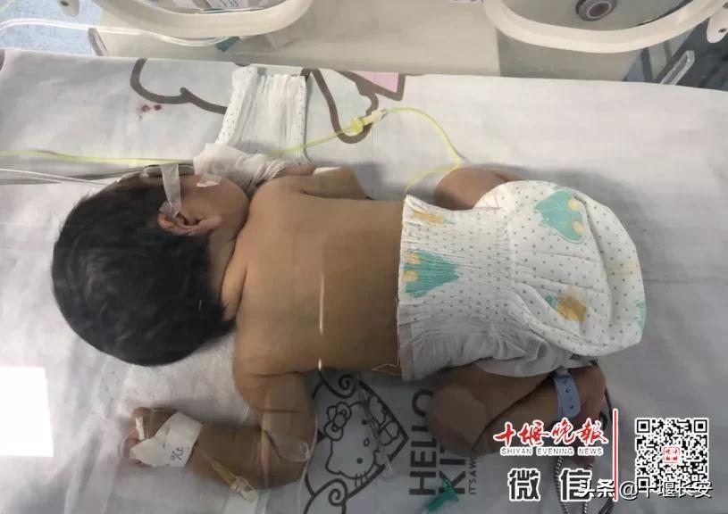 刚出生就换血怎么回事,出生10天全身换血严重吗