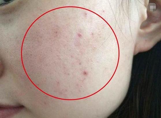 毛孔很大可以用什么填充,毛孔大可以一直用的精华