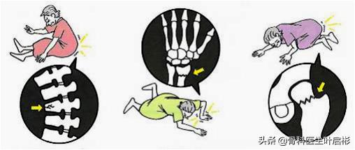 老年人骨折危险在哪里,如何辨别老年人是否骨折