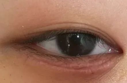 眼整形修复权威科普,科普眼整形手术是个什么手术多图