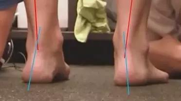 有效预防拇指外翻和扁平足,为了预防扁平足我们要穿什么鞋